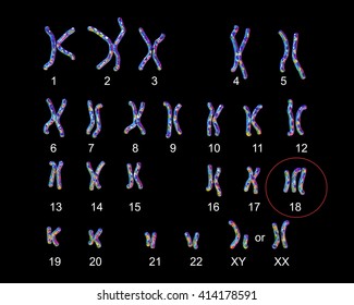 Edwards-syndrome Karyotype, Labeled. Trisomy 18. 3D Illustration