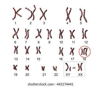 Edwards-syndrome Karyotype, Labeled. Trisomy 18. 3D Illustration