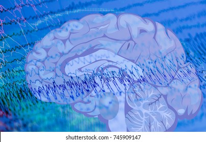  EEG wave in human brain, Brain wave patterns on electroencephalogram,problems in the electrical activity of the brain
