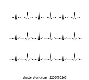 Electro Cardiogram Arrhythmia Circulatory System Electrocardiogram