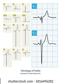 The Electrocardiogram Characteristic Of Tetralogy Of Fallot Is Right Ventricular Hypertrophy