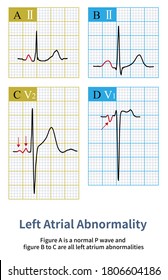 The Electrocardiogram Features Of Abnormal Left Atrium Are P Wave Widening, Notch And P Wave Terminal Potential Increase In Lead V1.