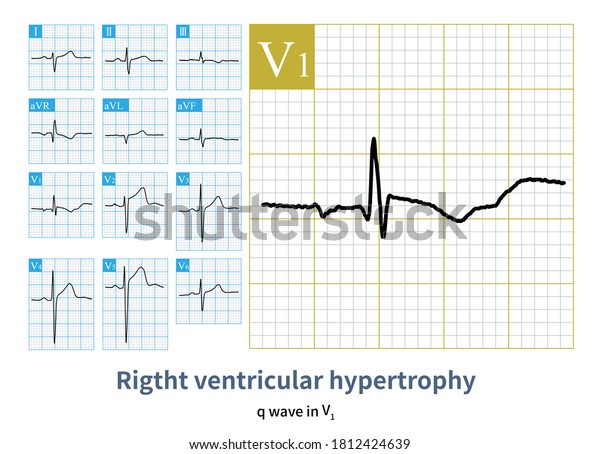 Electrocardiogram Patient Atrial Septal Defect Q Stock Illustration ...