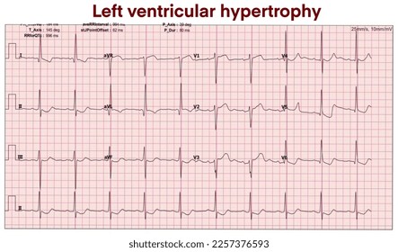 Electrocardiogram show Left ventricular hypertrophy. Heart beat. CPR. ECG. EKG. Vital sign. Life support. Medical healthcare symbol. - Powered by Shutterstock