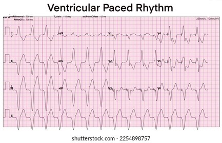 Electrocardiogram show ventricular paced rhythm (V-PC). Heart beat. Pacemaker. CPR. ECG. EKG. Vital sign. Life support. Medical healthcare symbol. - Powered by Shutterstock