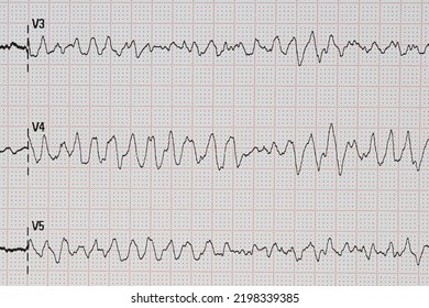 Electrocardiogram Showing Fatal Ventricular Fibrillation