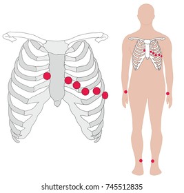 Electrocardiography, ECG Or EKG, Electrode Placement In The Body. Electrodes Are Placed To Arms, Legs And Chest In Intercostal Space.