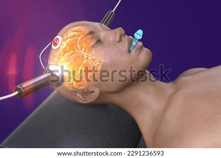 Electroconvulsive therapy, ECT, a treatment used for severe mental illnesses involving the use of electrical currents to stimulate the brain, 3D illustration