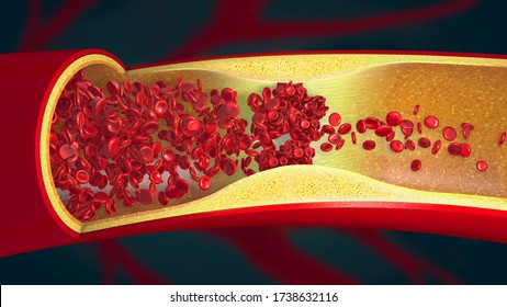 Embolism Caused By A Blood Clot In A Constricted Blood Vessel - 3d Illustration