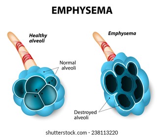 Emphysema. Damage To The Air Sacs In Lungs. Chronic Obstructive Pulmonary Disease. 