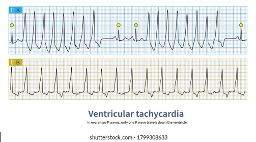 Sinus Tachycardia Images Stock Photos Vectors Shutterstock