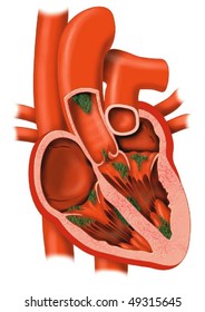 Endocarditis