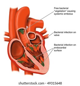 Endocarditis -- Labeled