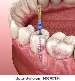 Endodontischer Wurzelbehandlung. Medizinisch genaue 3D-Abbildung der Zähne.