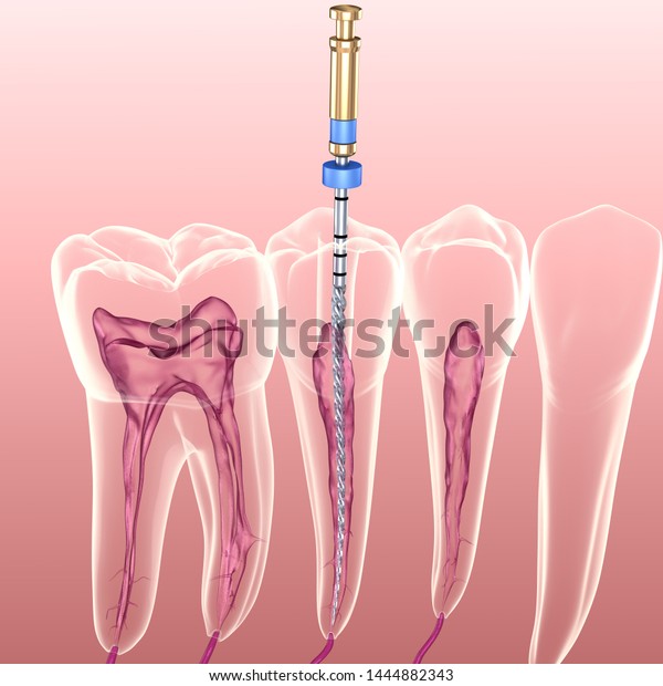 Endodontic root canal treatment process.\
Medically accurate tooth 3D\
illustration.