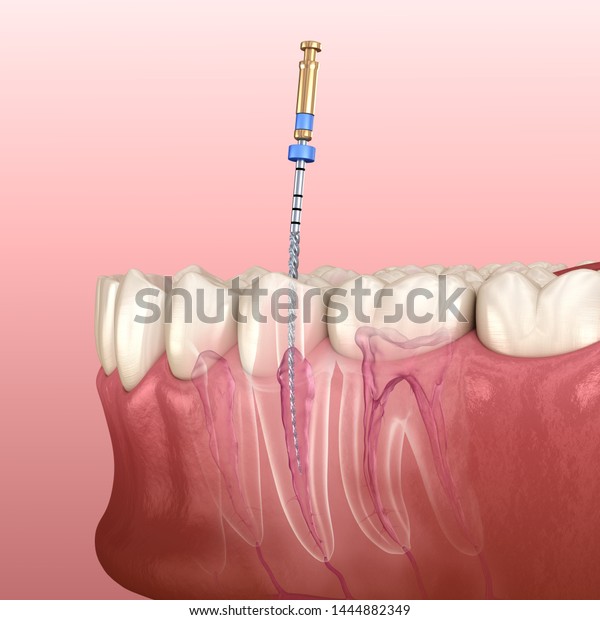 Endodontic Root Canal Treatment Process Medically Stock