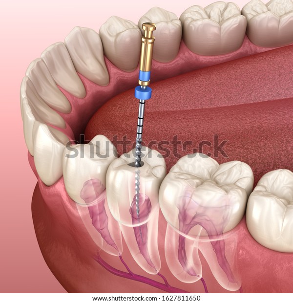 Endodontic root canal treatment process.\
Medically accurate tooth 3D\
illustration.