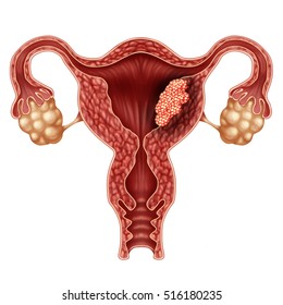 Endometrial Cancer As A Uterus Or Uterine Cancer Medical Concept As Cancerous Cells In A Female Body And Cervical Tumor Growth Treatment Diagnosis And Symptoms With 3D Illustration Elements.