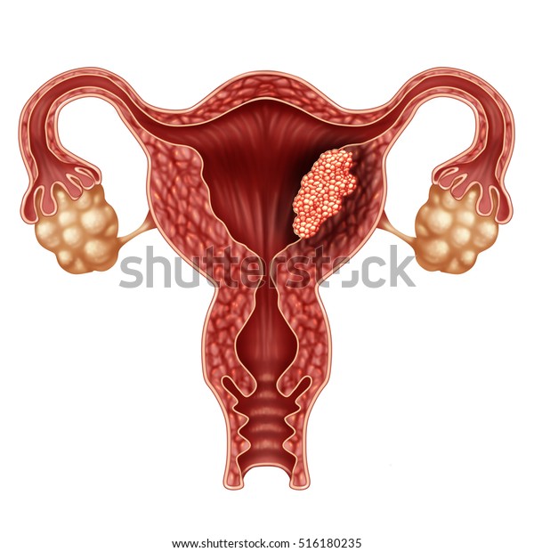 Endometrial Cancer Uterus Uterine Cancer Medical 库存插图516180235