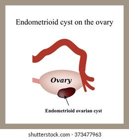 Endometrioid Cyst On Ovary Endometriosis Ovary Stock Illustration ...