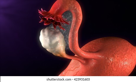 826 Uterine endometriosis Images, Stock Photos & Vectors | Shutterstock