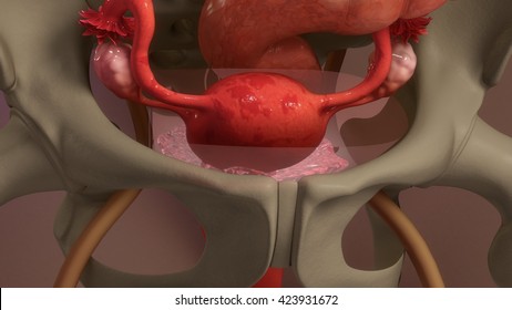 Endometriosis 3d Illustration