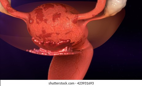 Endometriosis 3d Illustration