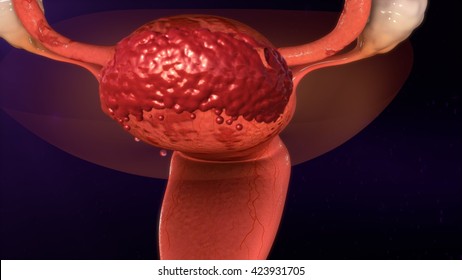 Endometriosis 3d Illustration