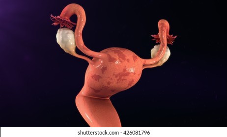 Endometriosis  3d Illustration