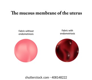 826 Uterine endometriosis Images, Stock Photos & Vectors | Shutterstock