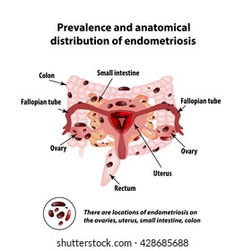 Endometriosis. The Appearance Of The Disease Endometriosis. 