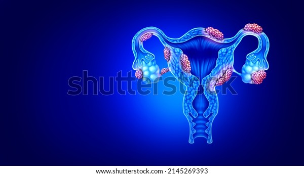 Endometriosis disease anatomy concept of female\
infertility condition as uterus avaries and fallopian tubes with\
tissue growth with 3D illustration\
elements.