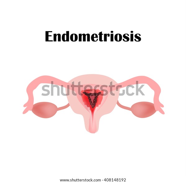 Endometriosis Structure Pelvic Organs Adenomyosis Endometrium Stock Illustration 408148192 1355