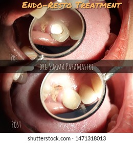 Endo-Resto Dental Filling Materials With Composite Filling