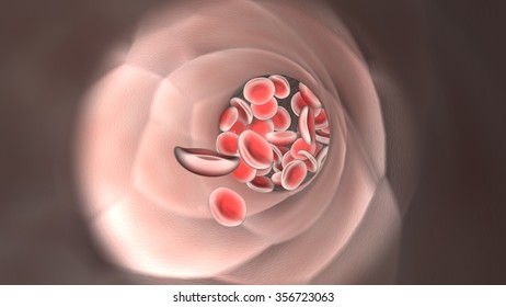 Colon Cancer Colonoscope Colon Polyp Removal3d Stock Illustration 637875997   Endoscopic View Flowing Red Blood 260nw 356723063 