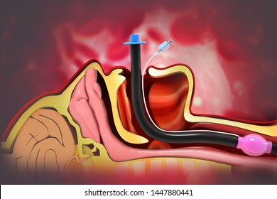 Endotracheal Intubation On Scientific Background. 3d Illustration