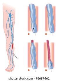 Endovenous Laser Treatment Varicose Vein Ablation