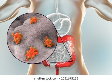 Entamoeba histolytica protozoan infection of large intestine. Parasite which causes amoebic dysentery and ulcers. 3D illustration Stock Illustration