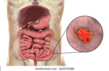 Entamoeba histolytica protozoan infection of large intestine. Parasite which causes amoebic dysentery and ulcers. 3D illustration Stock Illustration
