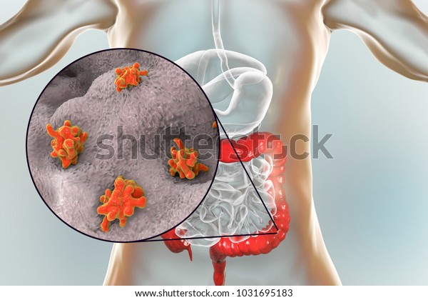 大腸の赤痢アメーバ原虫感染症 アメーバ性赤痢や潰瘍を引き起こす寄生虫 3dイラスト のイラスト素材