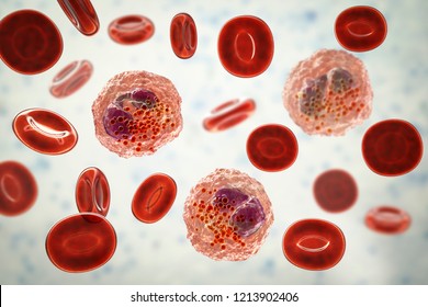 Eosinophilia, blood smear showing multiple eosinophils surround by red blood cells, 3D illustration. Eosinophilia occurs in parasitic and fungal infections, allergies, autoimmune disorders, tumors
