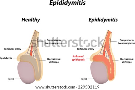 Epididymitis   229502119 Shutterstock