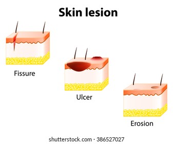 Erosion, Ulcer And Fissure. Skin Lesion.