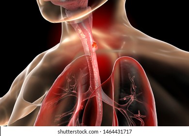 Esophageal Cancer, 3D Illustration Showing Malignant Tumor In The Human Esophagus