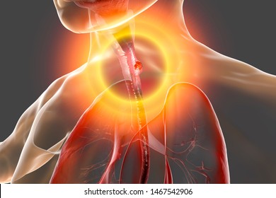 Esophageal Cancer, 3D Illustration Showing Malignant Tumor In The Human Esophagus