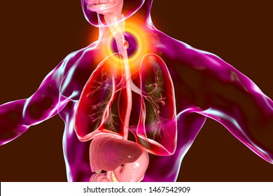 Esophageal Cancer, 3D Illustration Showing Malignant Tumor In The Human Esophagus