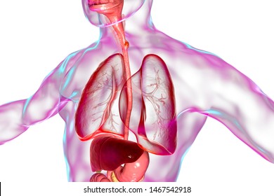 Esophageal Cancer, 3D Illustration Showing Malignant Tumor In The Human Esophagus