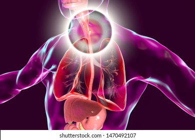 Esophageal Cancer 3d Illustration Showing Malignant Stock Illustration ...