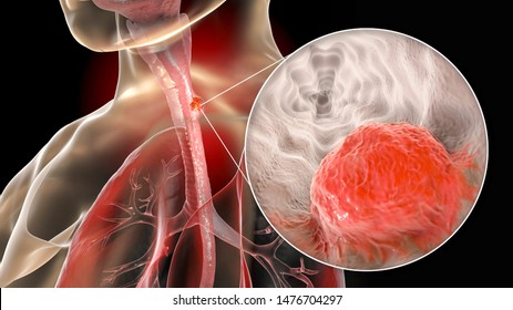 Esophageal Cancer, 3D Illustration Showing Malignant Tumor In The Human Esophagus