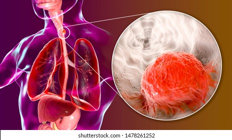 Esophageal Cancer, 3D Illustration Showing Malignant Tumor In The Human Esophagus